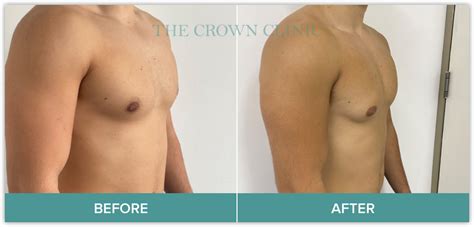gynecomastia melbourne fl|Gynecomastia .